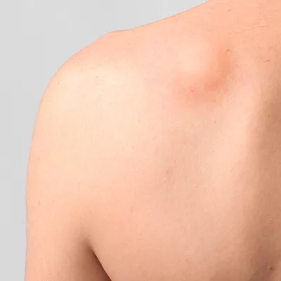 Remoção de Lipoma ou Cisto Sebáceo
