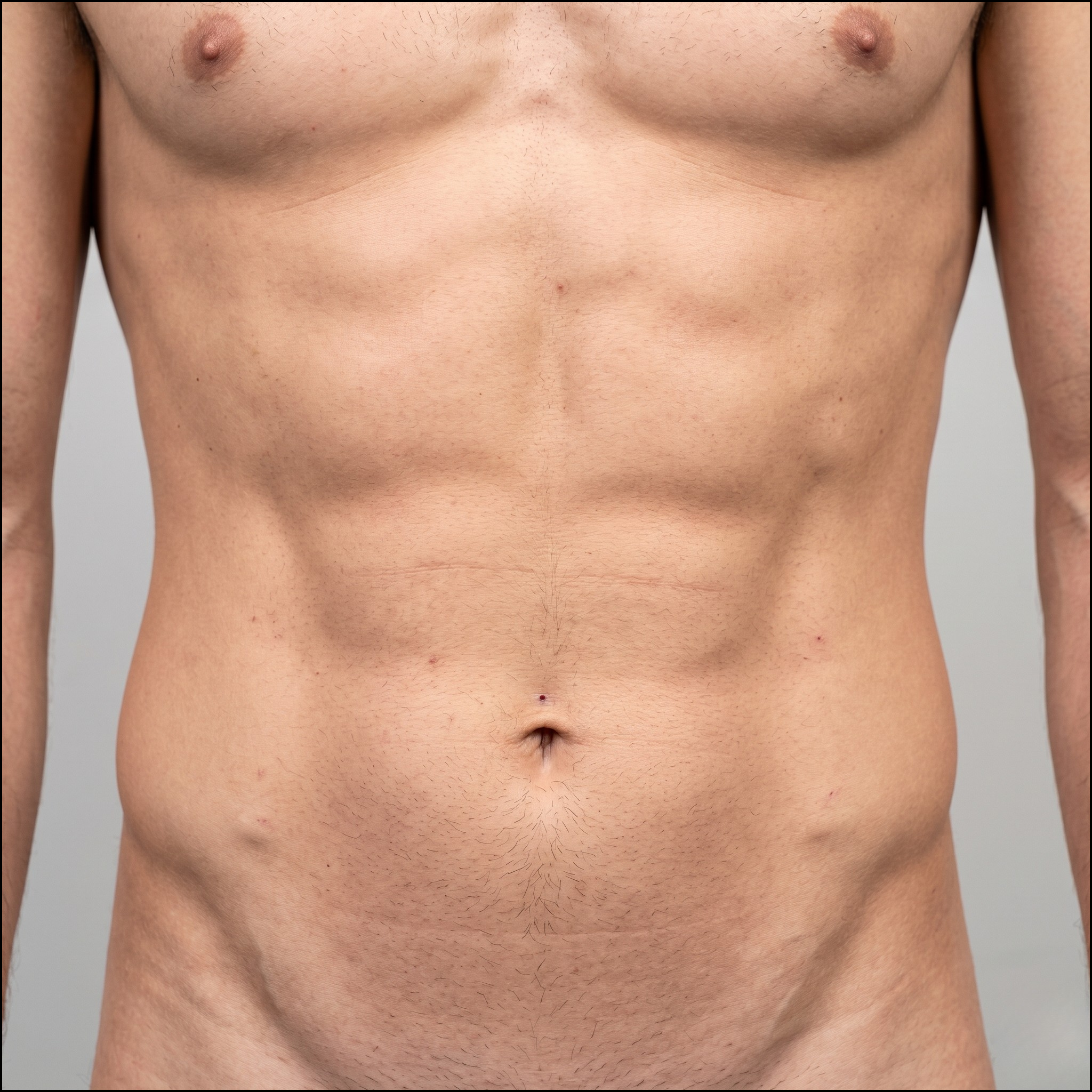 Lipoaspiração HD