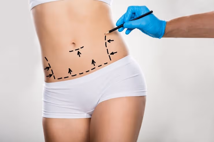 Mini Abdominoplastia